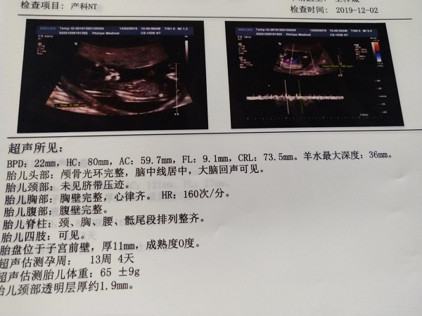 NT检查是孕期评估胎儿是否患有唐氏综合征的一种超声检查办法