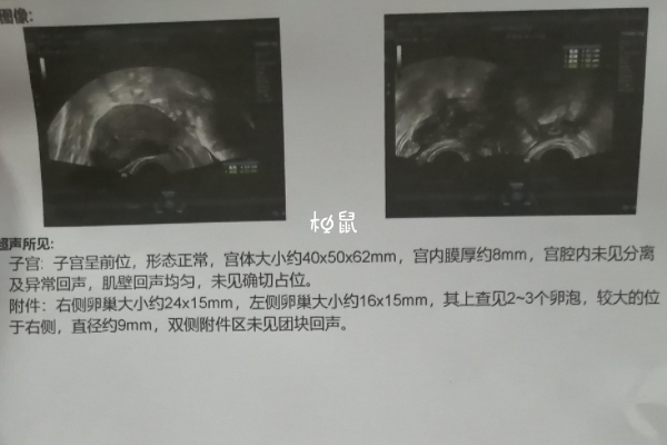 阴超监测卵泡的价格在120-150元