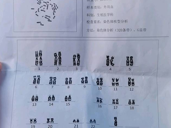 嵌合异常属于染色体异常