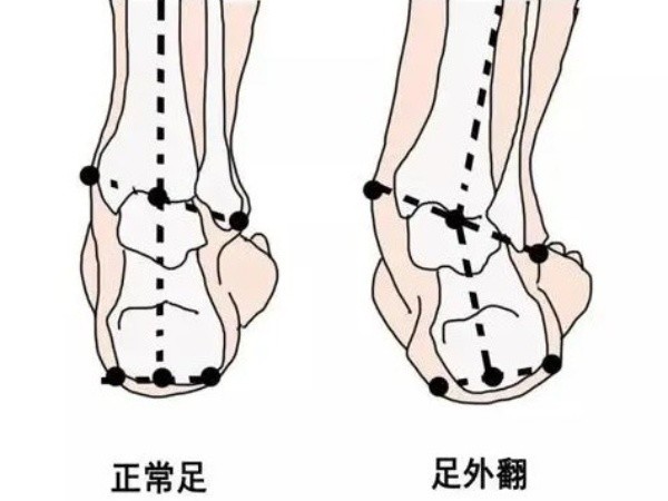 宝宝足外翻和正常足的区别