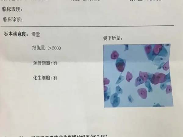 宫颈炎分为轻中重三度