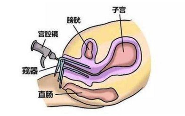 宫腔灌注的利弊